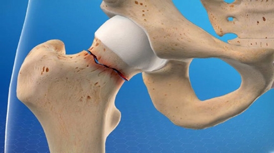 ارتباط مصرف تیرزپاتید با خطر پوکی استخوان در بیماران مبتلا به دیابت نوع ۲ یا چاقی 